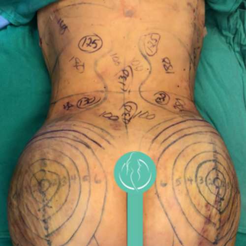Brazilian Butt Lift with Lipo 360° Plastic Surgery Dr